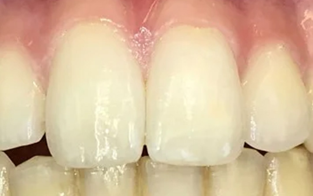 After treatment