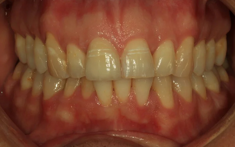 After treatment