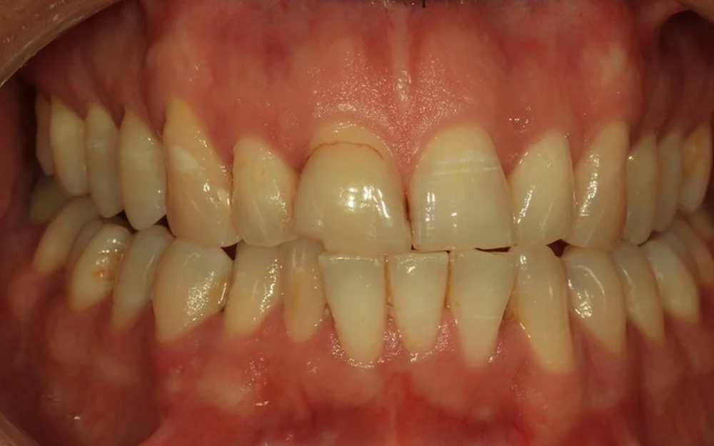 Before treatment