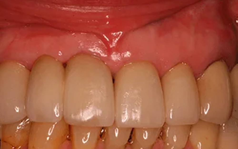 After treatment