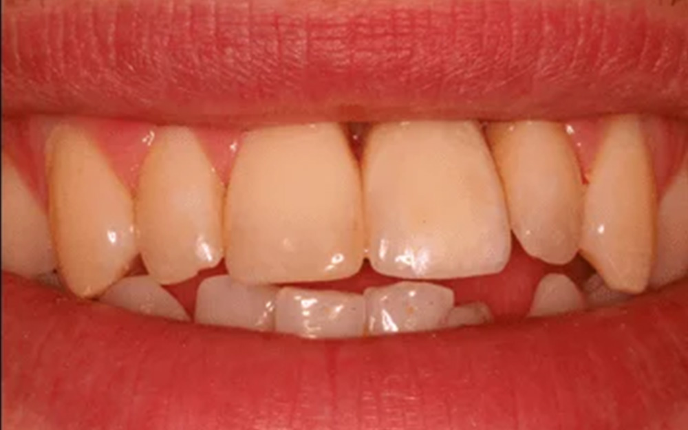 After treatment