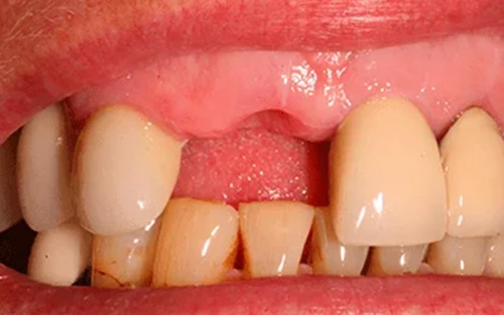 Before treatment