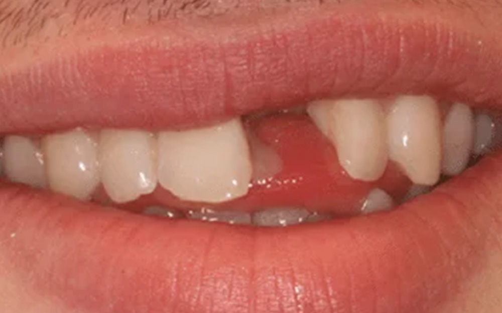 Before treatment