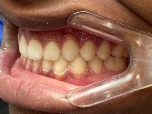 , Adult Orthodontics Gallery