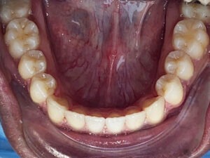 , Adult Orthodontics Gallery