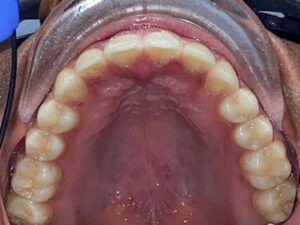 , Adult Orthodontics Gallery