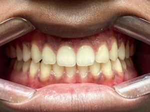 , Adult Orthodontics Gallery