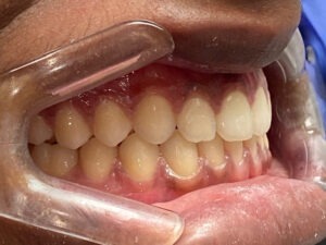 , Adult Orthodontics Gallery