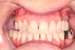 , The Benefits of In-House 3D Design and Printed Veneers