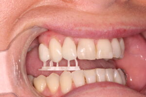 , The Benefits of In-House 3D Design and Printed Veneers