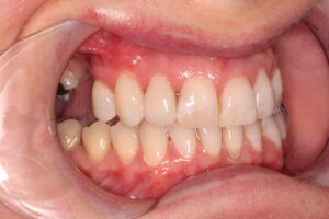 , The Benefits of In-House 3D Design and Printed Veneers