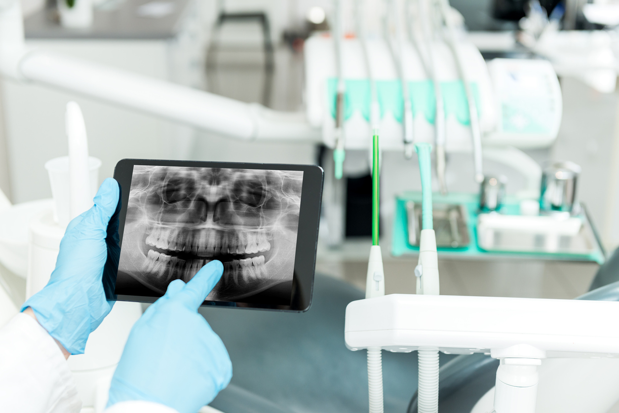 Trios Intraoral Scanner – no more putty moulds! 