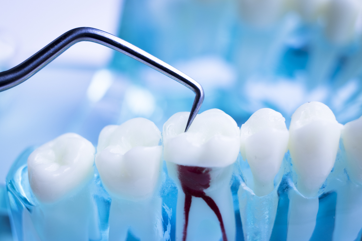 , Root Canal Treatment: A Guide to Painless Dental Care in Oxford