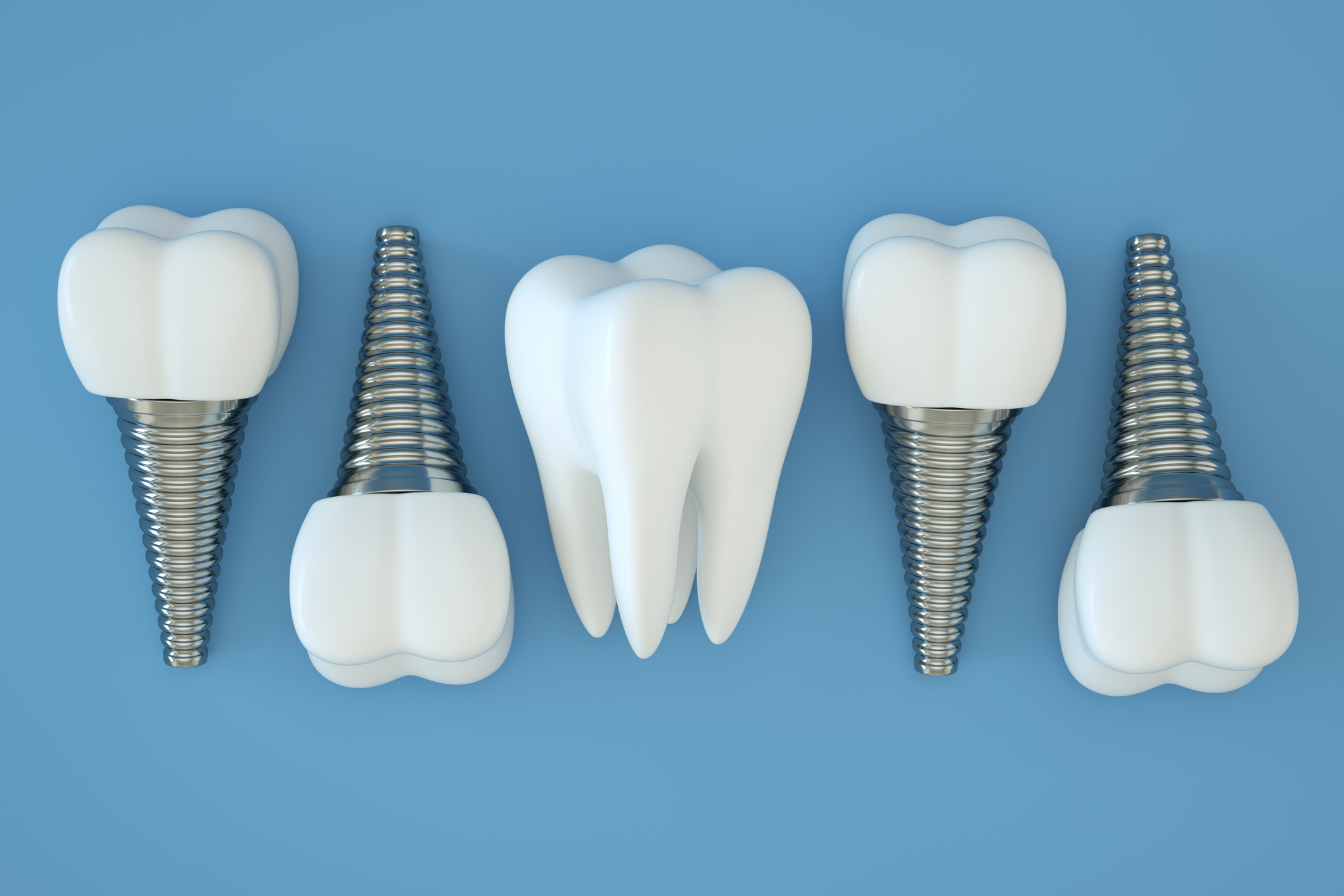 , Reclaim your smile, reclaim your life: The confidence-boosting power of dental implants in Oxford