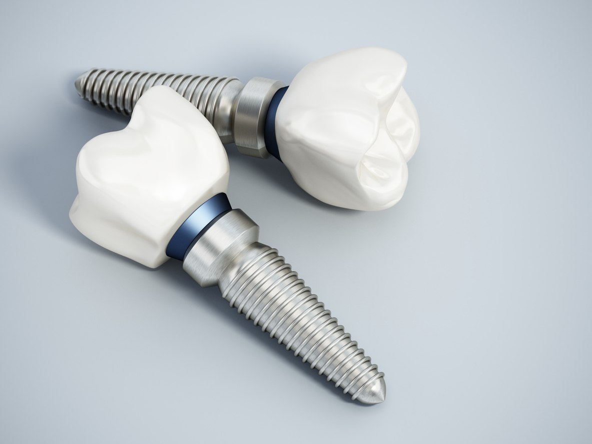 , Advanced technology to provide the best dental implants in Oxford