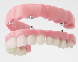 , Full arch dental implants: Restore your smile today