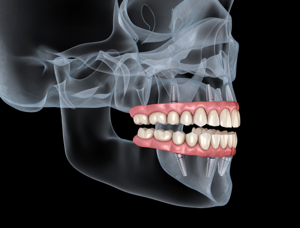 , Say goodbye to dentures: Your guide to full arch dental implants in Kidlington