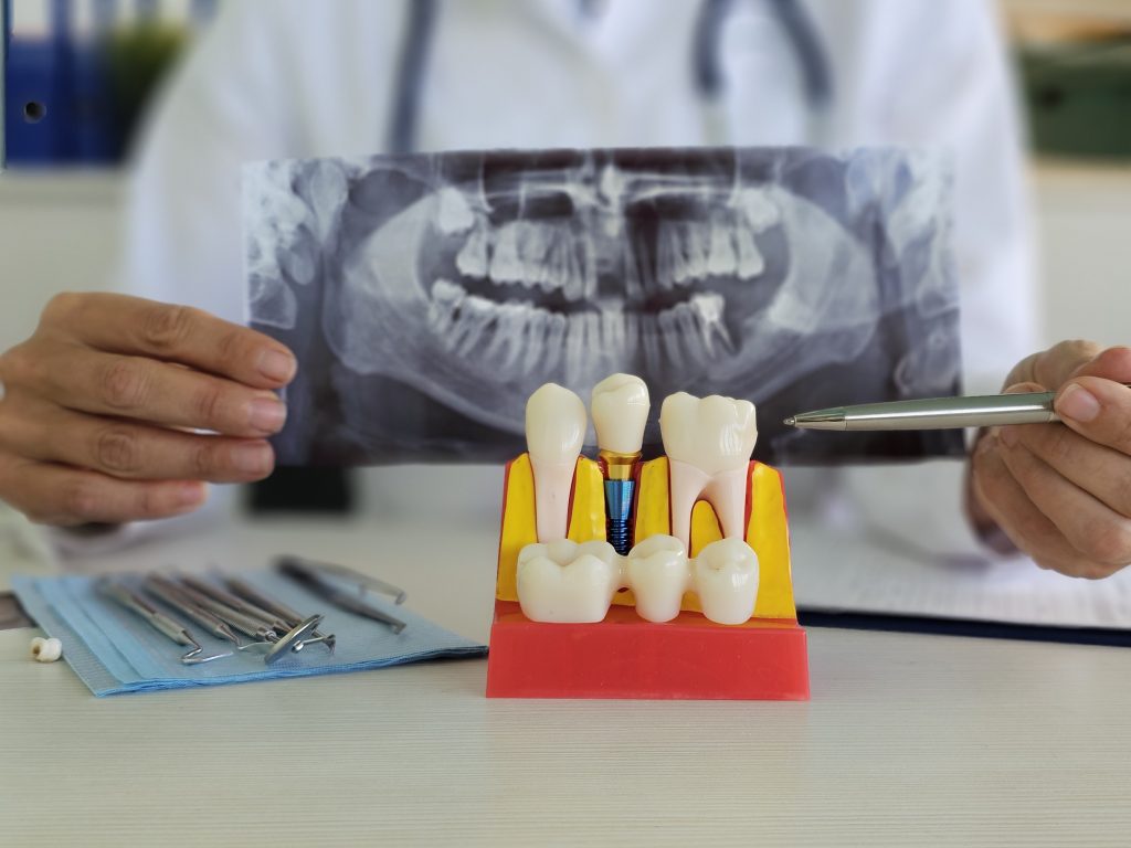 , Say goodbye to dentures: Your guide to full arch dental implants in Kidlington