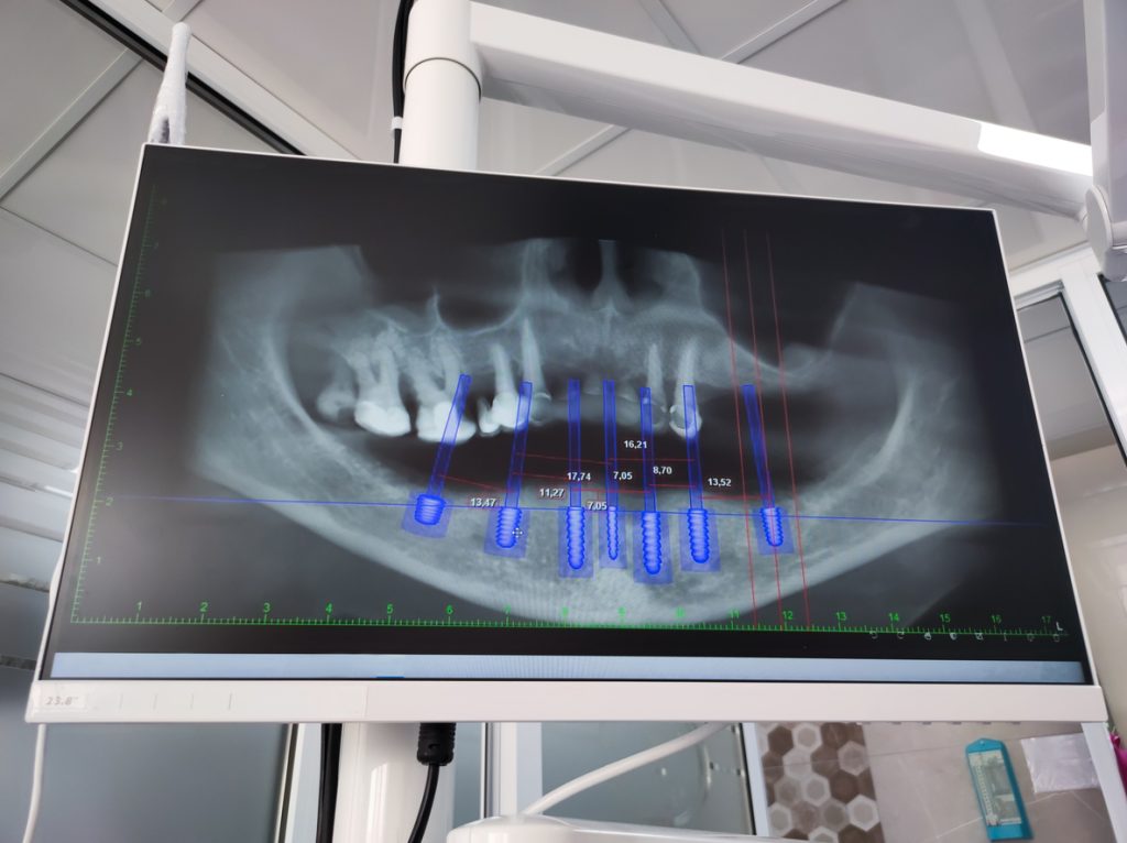 , Reclaim your smile: Everything you need to know about dental implants