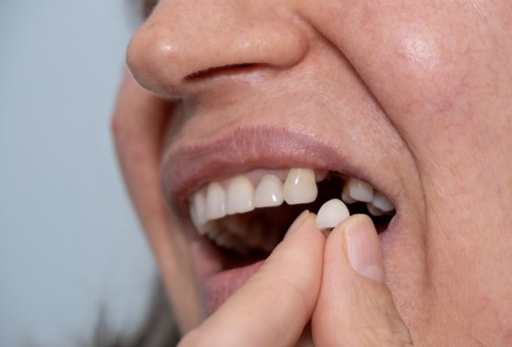 , Reclaim your smile: Everything you need to know about dental implants
