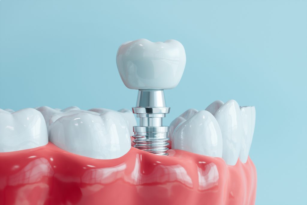 , Reclaim your smile: Everything you need to know about dental implants